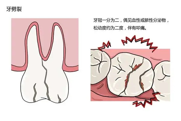 根管治疗后不做牙冠会怎样?