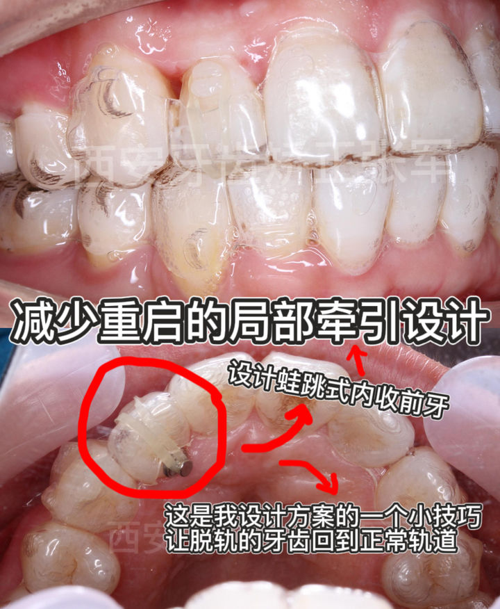 西安透明式牙齿矫正器龅牙,昆明牙齿矫正改变脸型