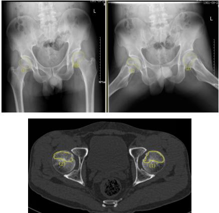 富血小板血浆治疗骨头坏死,富血小板血浆prp疗法多久见效