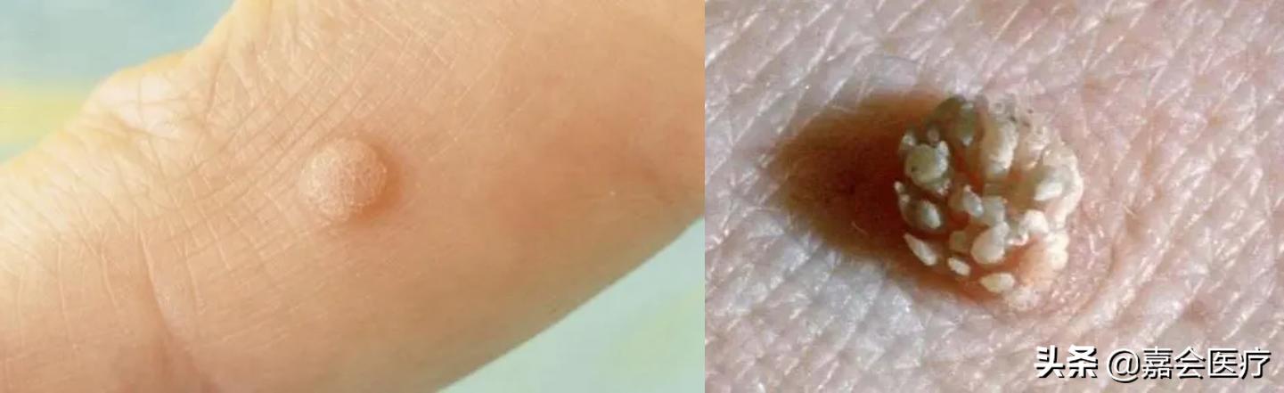 hpv感染医生建议检查宫腔镜,感染hpv产检能发现吗