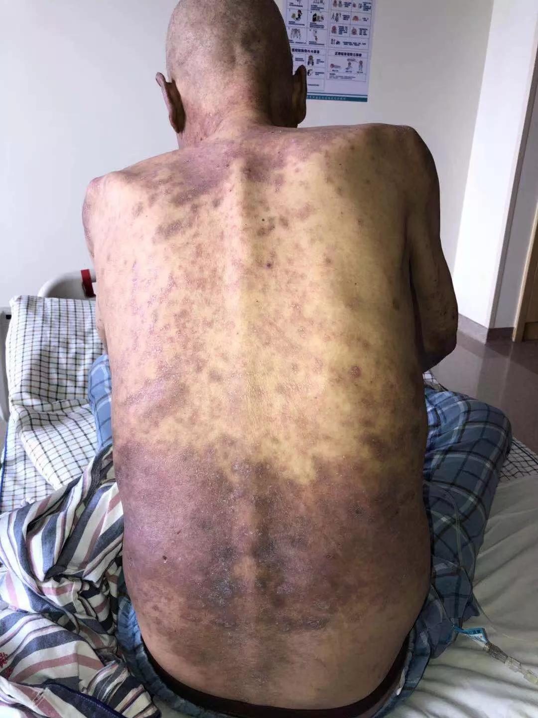 免疫治疗不良反应及处理方法,免疫治疗不良反应的处理