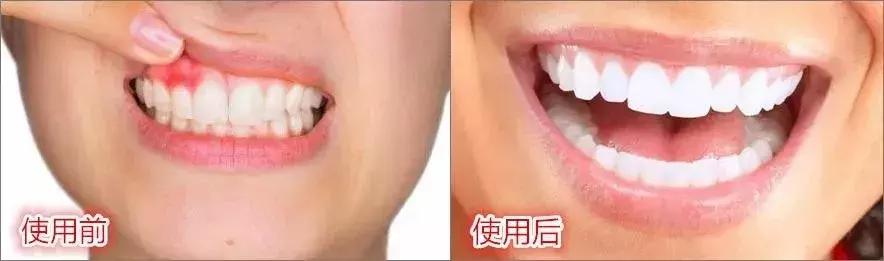 一口黄牙能洗白吗,一口黄牙毁了一张脸