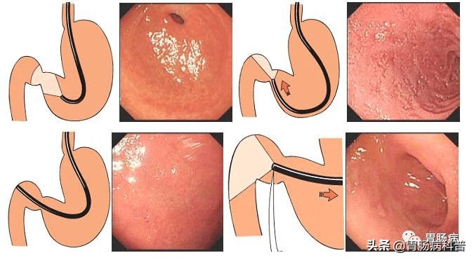 北大肿瘤医院院长沈琳:哪些人需要做胃镜?该做的人千万别犹豫