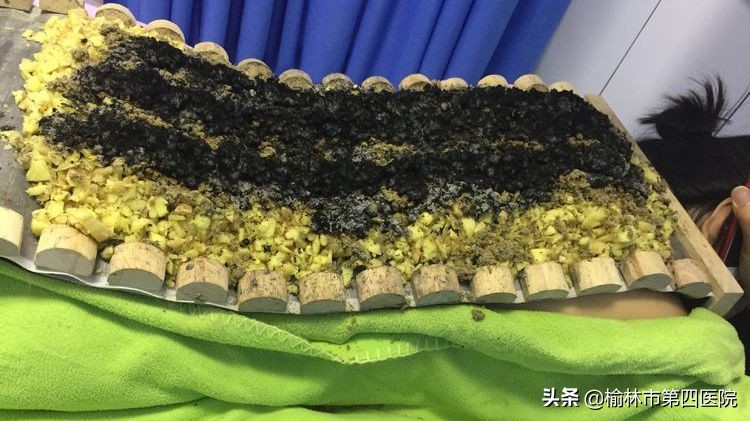 榆林市星元医院“冬病夏治”贴敷治疗项目正式启动