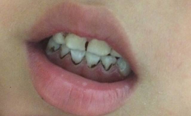 小朋友的牙菌斑要怎么去除,孩子有牙菌斑用什么刷牙