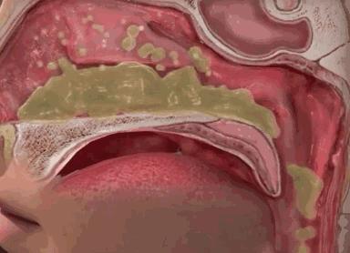 小孩一到晚上就咳白天不怎么咳,孩子一到晚上就咳嗽白天又不咳