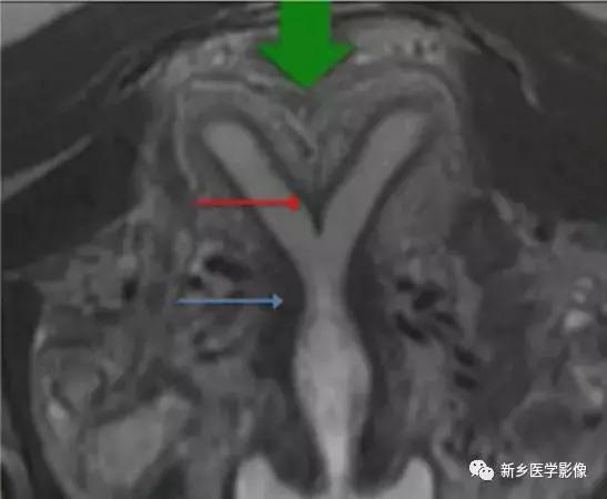 子宫发育异常,应想到的6大类常见畸形