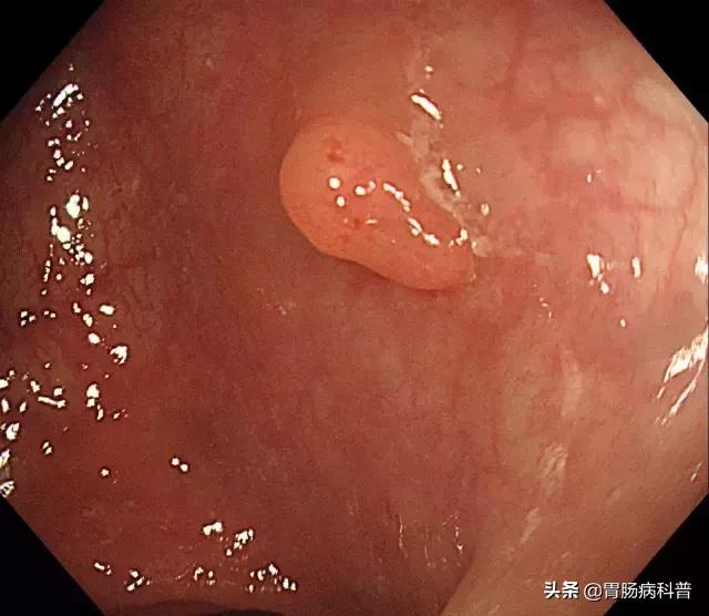 长胃息肉要注意什么,胃长息肉要注意什么