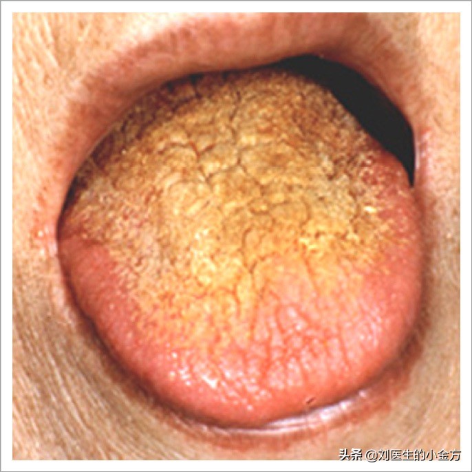 中医舌诊图解100例,中医舌诊图与舌诊口诀