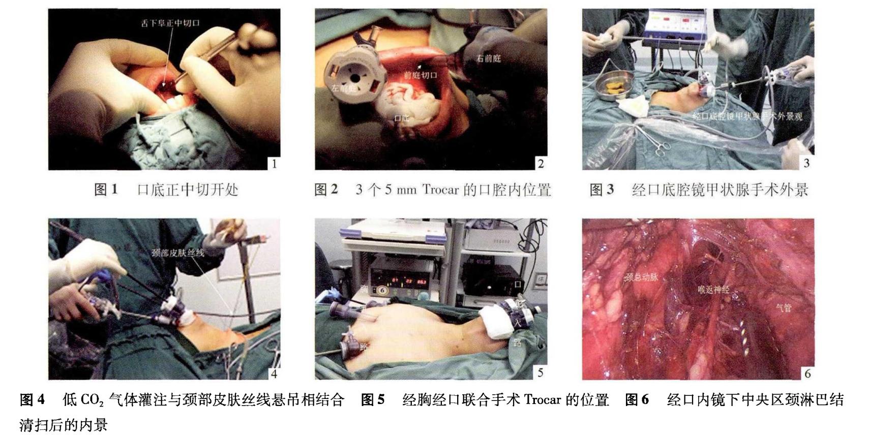 甲状腺结节三种诊断和处理方法,刚查过来的甲状腺结节怎么治疗