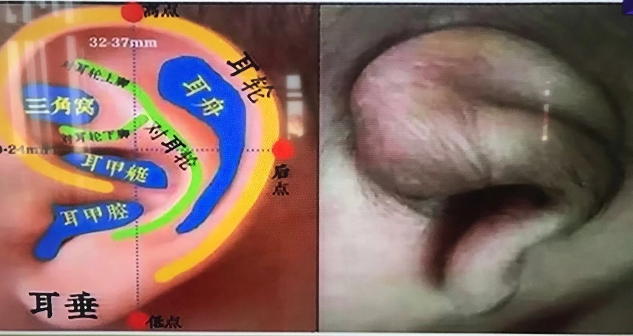 耳朵软骨畸形能矫正吗,新生儿耳朵畸形矫正费用大概多少