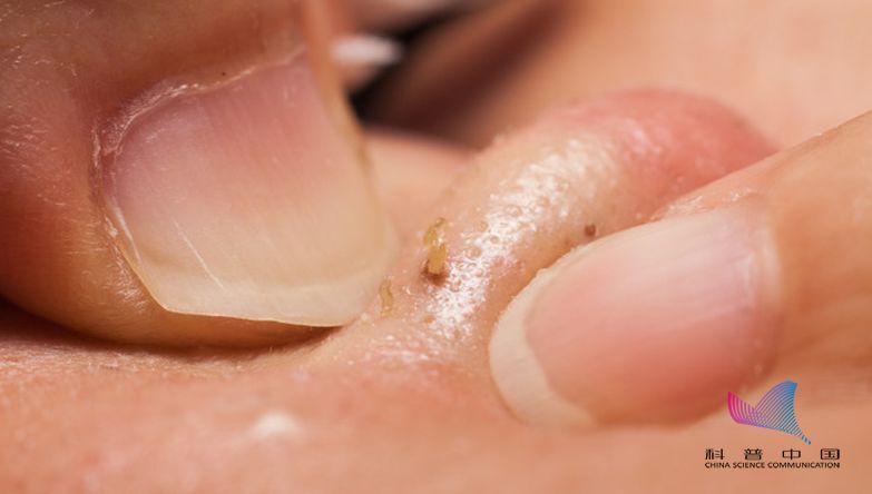 鼻子皮肤挤出来的白色东西是什么,鼻子上挤出来的白色分泌物是什么