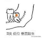 智齿分轻重嘛,智齿水平和非水平的区别