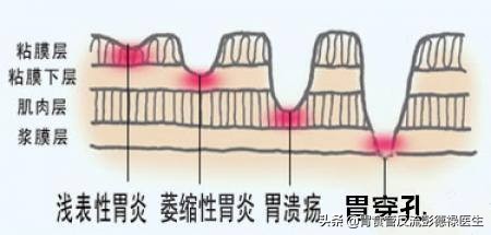 嗳气恶心干呕吃啥处方药,嗳气恶心心慌头晕是怎么回事