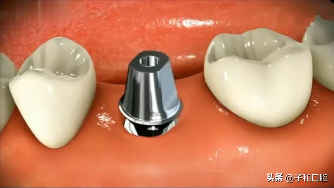 30秒看懂种植牙的全过程北大口腔,30秒看懂种植牙的全过程