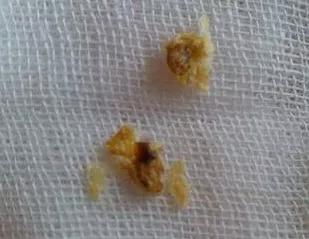 耳屎的颜色一般是什么,耳屎颜色有哪些