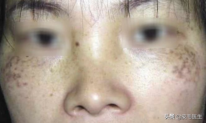 褐斑祛斑最有效方法,年轻人脸上长褐斑老年斑如何治疗
