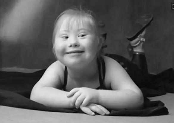 唐氏综合征中国美女,患有唐氏综合征的维密模特