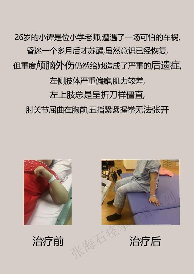 眼睑痉挛如何治疗,痉挛状态如何缓解