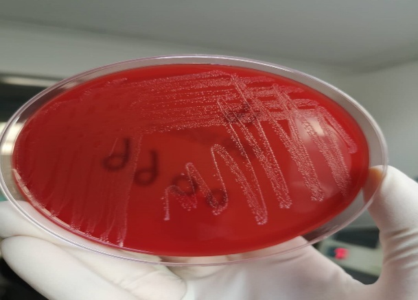 致死性B族链球菌感染,准妈妈不能忽视的产前筛查,你关注过吗?