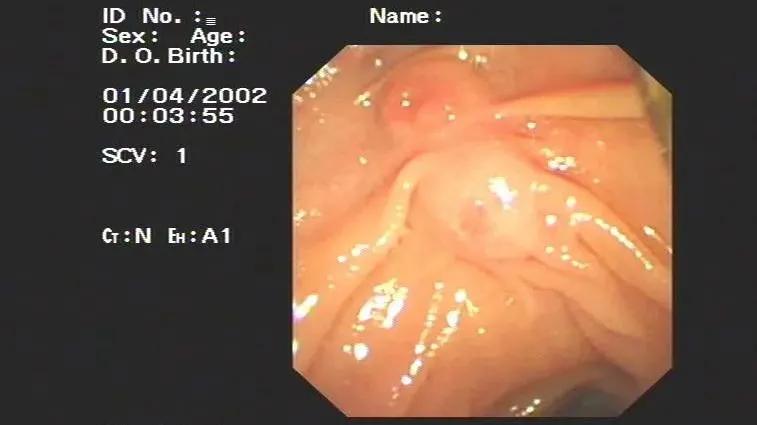 现在还存在蛔虫病吗,为何现在没人感染蛔虫了