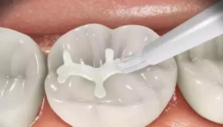 六龄牙终生不换,六龄牙有不换的吗