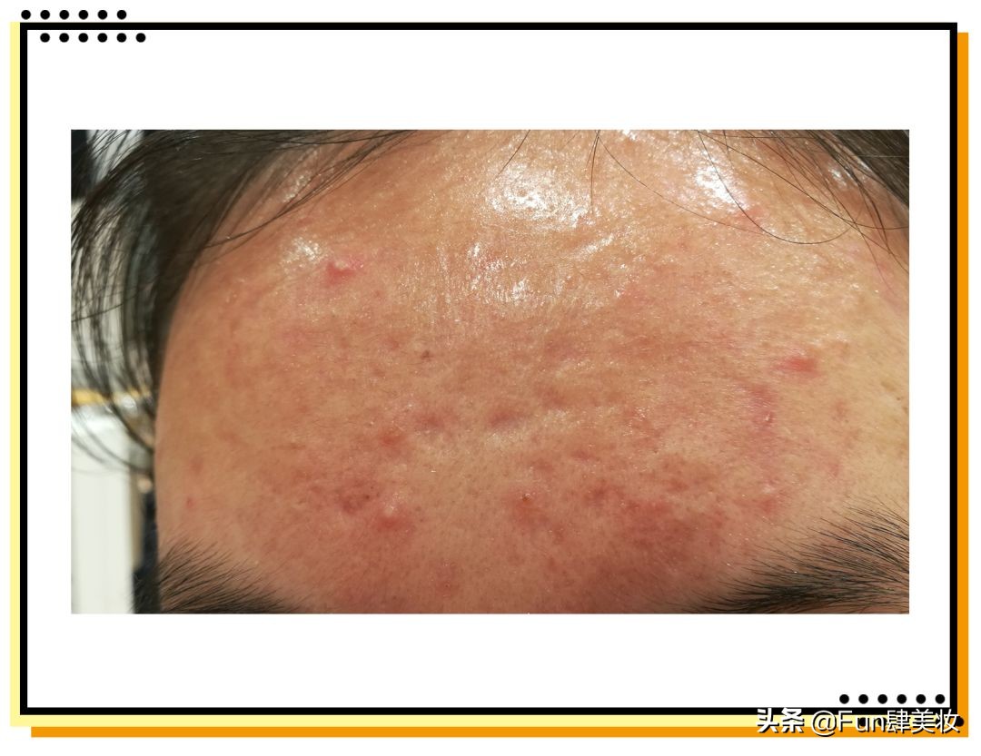 痘印痘坑真正祛除的方法,痘印痘坑去不掉怎么办