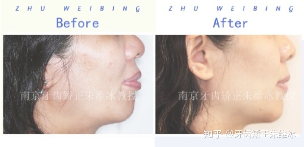 南京牙齿矫正龅牙前突要多少钱,36岁牙周不好龅牙能整吗