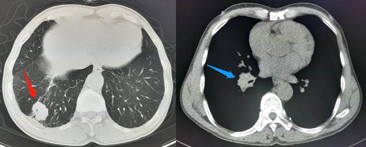 肺癌就像黑涩会，这3步重拳打出去，能抓住80%的肺癌团伙