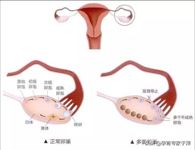 青岛助孕专家于萍：5大症状警惕“多囊”，有1招治疗需要您配合