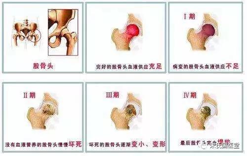 股骨头坏死漏诊图片,太康陈医生治疗股骨头坏死