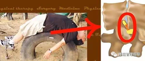 72岁老人腰疼还有骨刺该怎么治疗,老年人骨刺疼痛怎么治疗