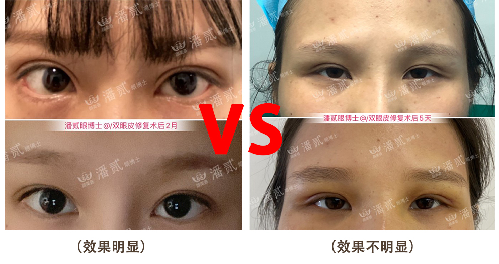 双眼皮离眉毛太近还能修复好吗,割双眼皮眉毛下面肿会消肿吗