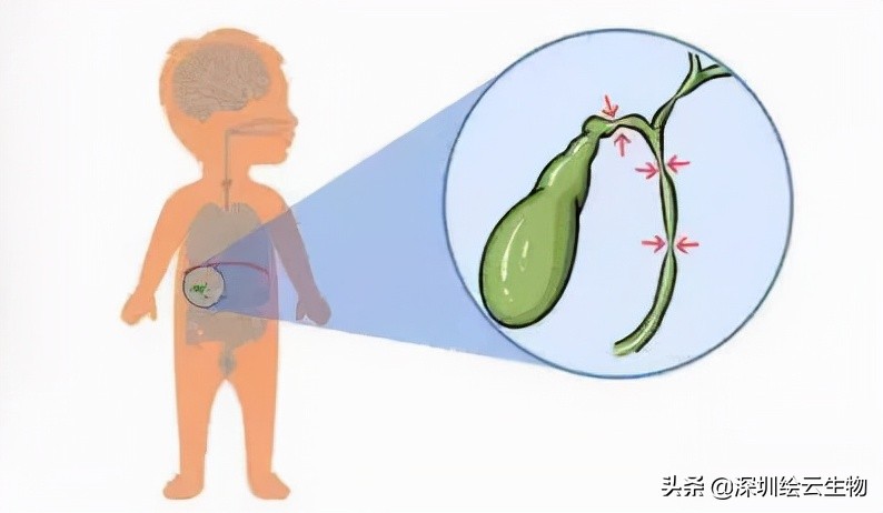 新生儿干血斑取样流程,新生儿胆道闭锁的血液指标