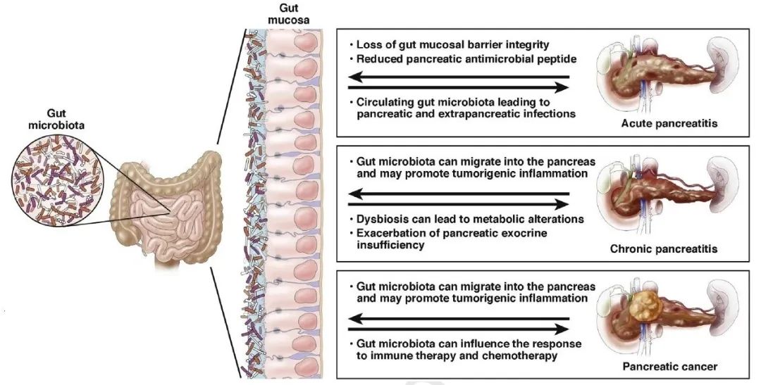 肠道菌群与胰岛素,肠道菌群与胰腺肿瘤