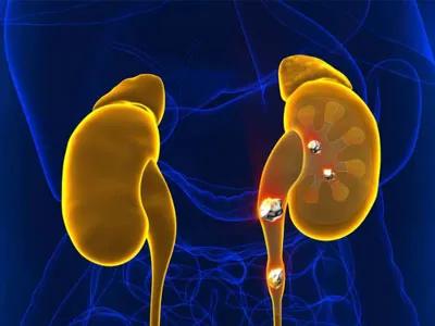 导致肾结石发病的诱因是什么,肾结石的症状怎么治疗