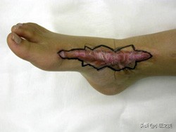 烫伤,以正确的方式治疗可帮助减轻疤痕增生