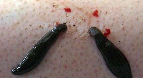 在农村被蚂蟥咬,在田里被蚂蟥咬了怎么办