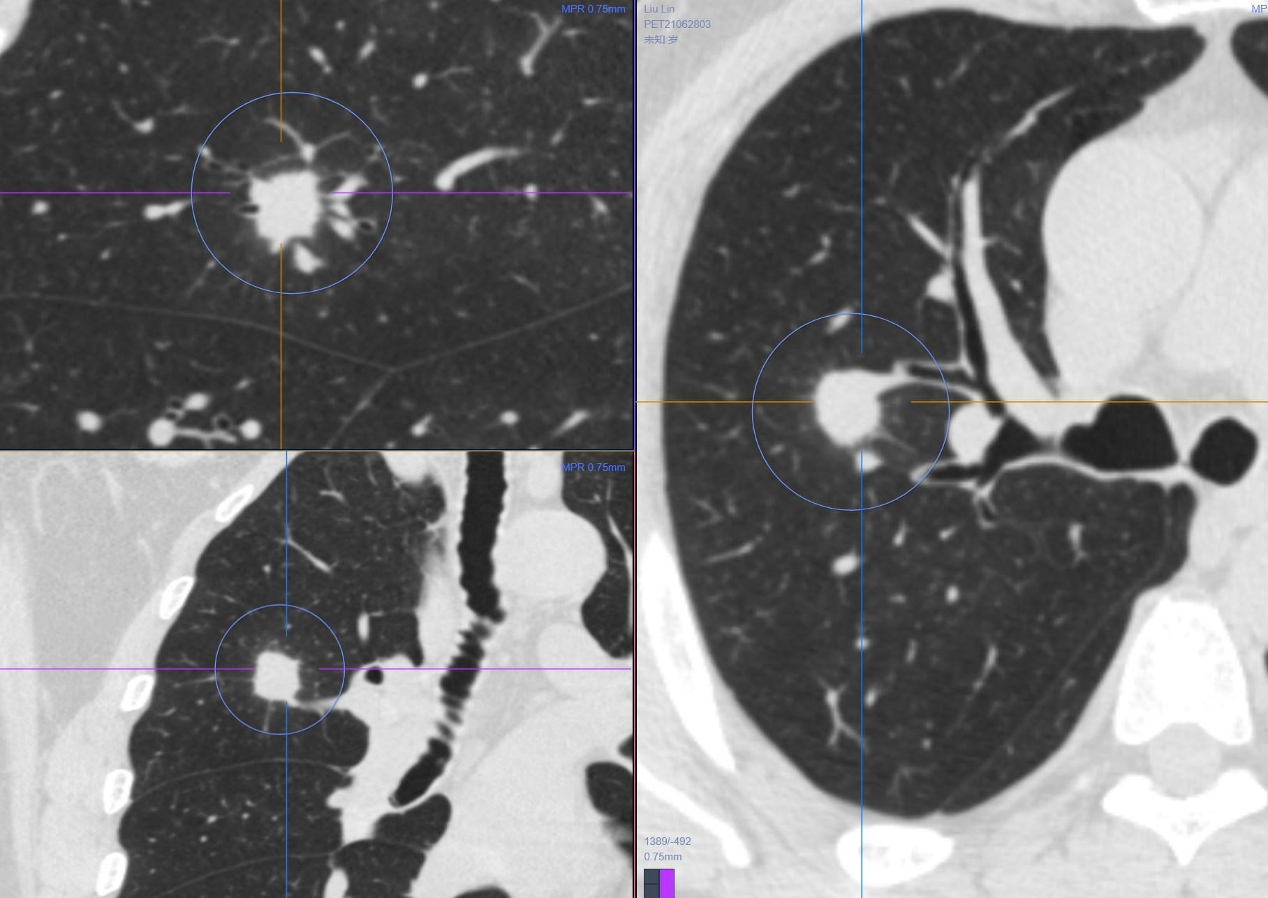 9mm肺结节实性结节良性几率多大,良性肺结节生长速度