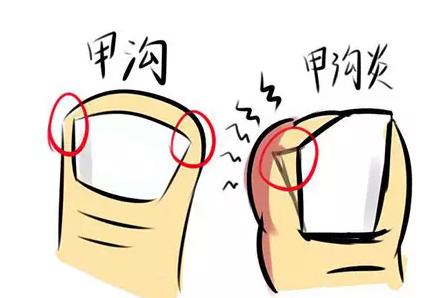脚趾肿痛有什么小妙招,小脚趾肿痛警惕四种病