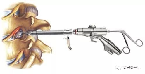 腰椎间盘突出腰腿疼怎么解决,腰椎4-5突出压迫右神经多久坏死