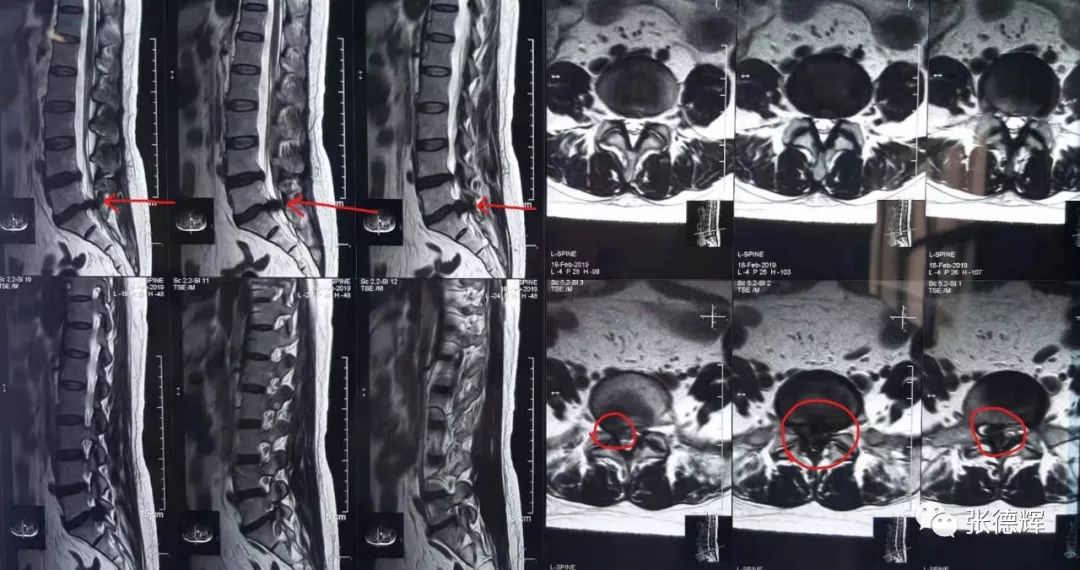 巨大腰间盘突出可以保守治疗吗,腰椎间盘突出不治疗越来越严重