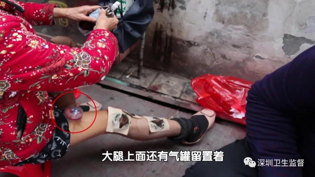 神医当街放血拔罐,神医扎针放血治百病