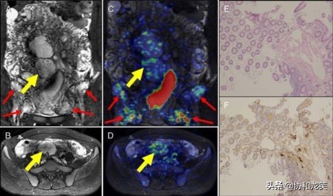 淋巴管瘤在68Ga-NOTA-EvansBluePET/MRI上的表现