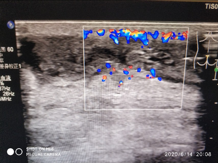 骶尾部囊肿手术多久可以弯腰,骶尾部囊肿和藏毛窦哪个严重