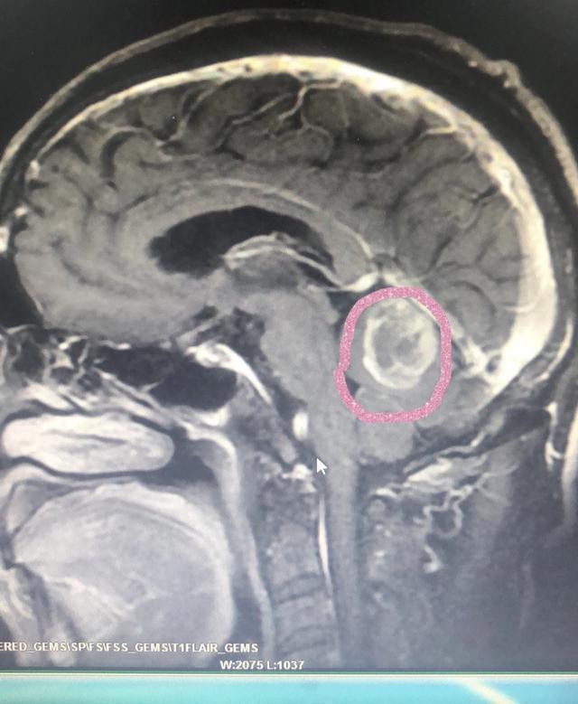 黑痣到底是什么样子,身上最可怕的黑痣