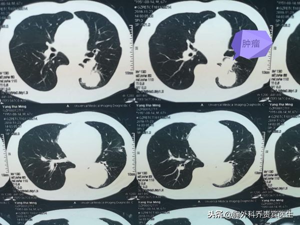 做手术只为了挽救生命,肺癌介入栓塞治疗不能延长生存期