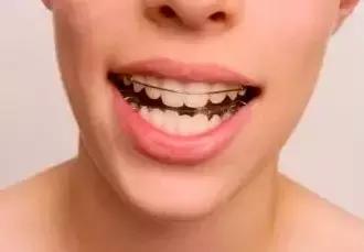 找了3个大学妹子聊聊:为什么在最美好的年纪戴牙套