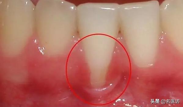 牙齿吃雪糕敏感怎么办,牙齿吃冰的就特别敏感怎么办