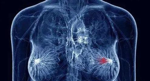 浆细胞性乳腺炎中医药方,浆细胞性乳腺炎的外科治疗